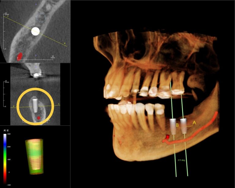 Zabieg wszczepienia implantu w nawigacji komputerowej